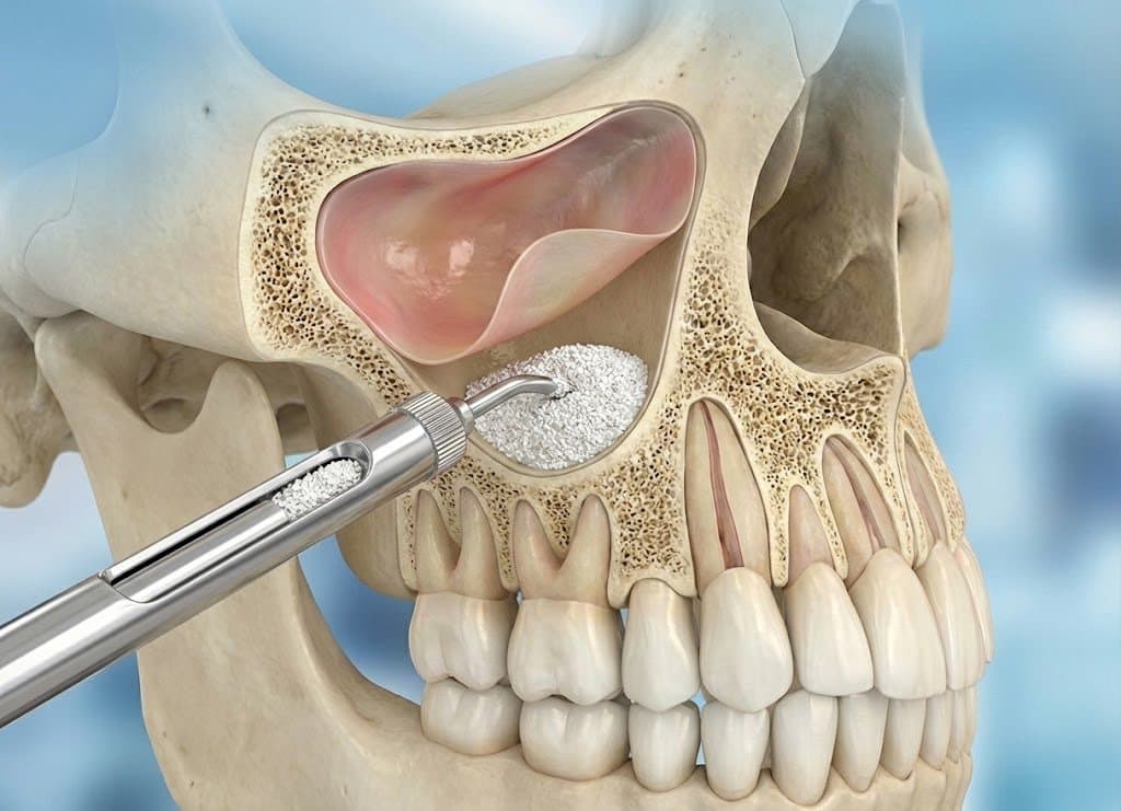 Sinus Lift ve Kemik Cerrahi