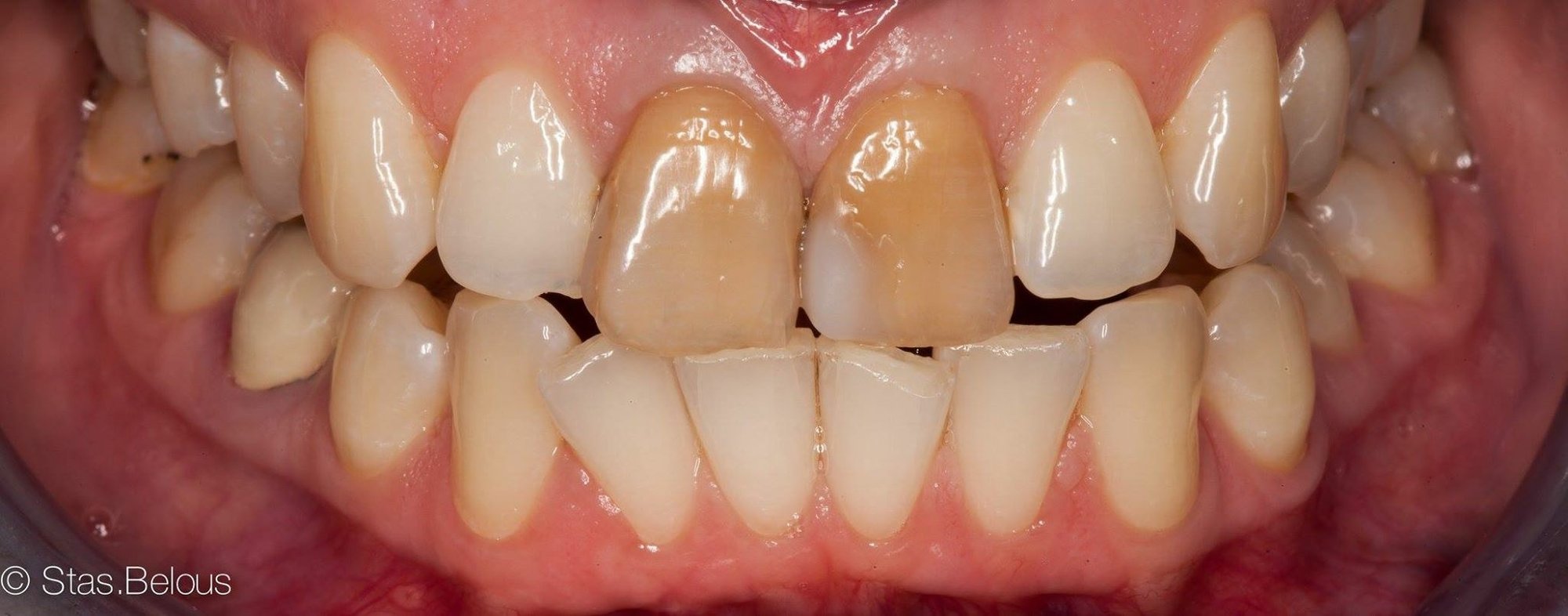 Smile Design